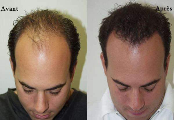 avant-apres-greffe-cheveux