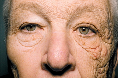 Vieillissement de la peau par le soleil. Effet de Dermathoheliosis sur une seule face du visage ayant été exposé journalièrement aux rayons du soleil. Photo Jennifer R.S. Gordon, M.D. y Joaquin C. Brieva, M.D. | NEJM